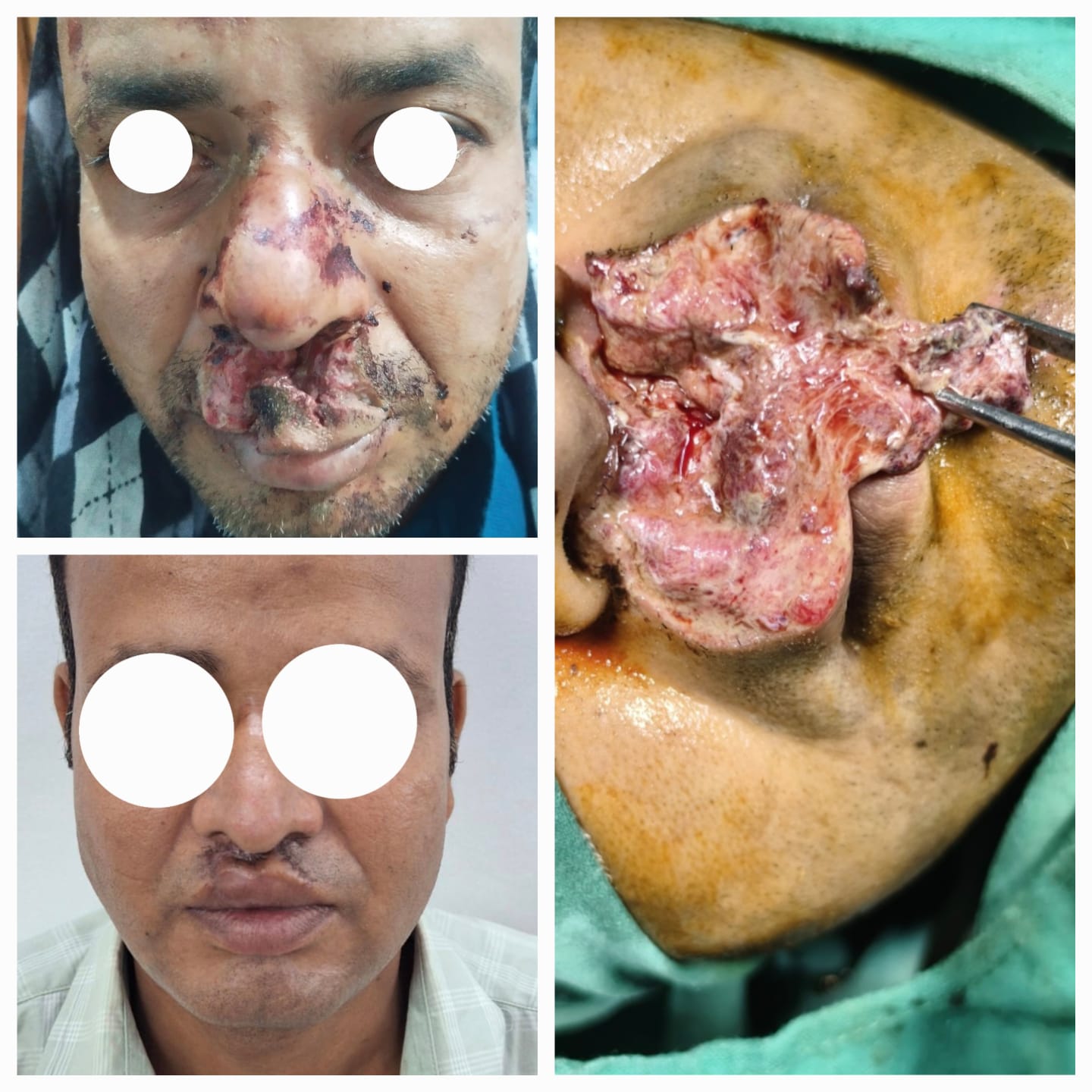 Maxillofacial fracture