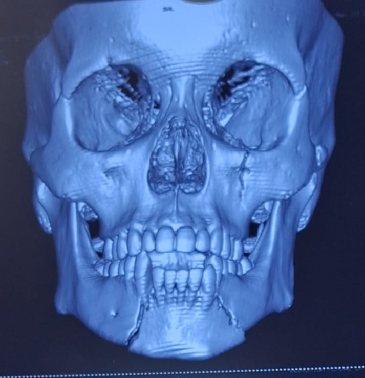 Mandible fracture