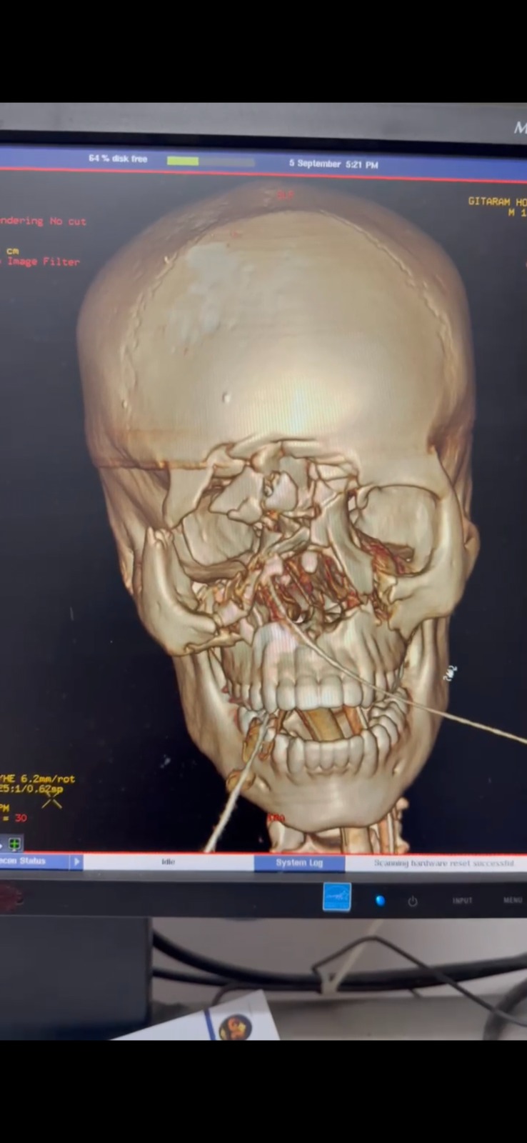 Panfacial Fracture