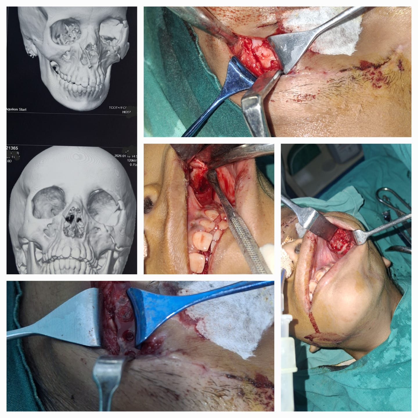 Pediatrics maxillofacial fracture