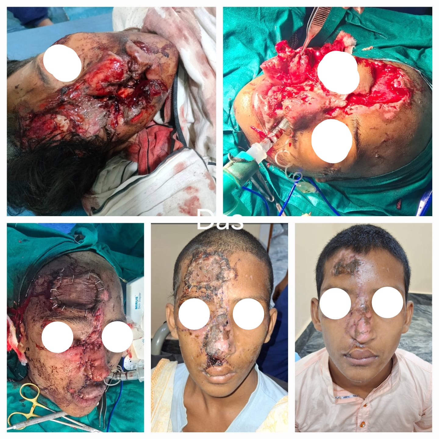Maxillofacial Trauma