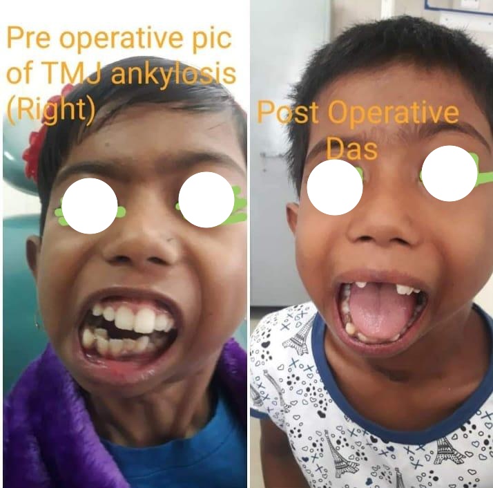 Pre Op and post Op unilateral TMJ ankylosis