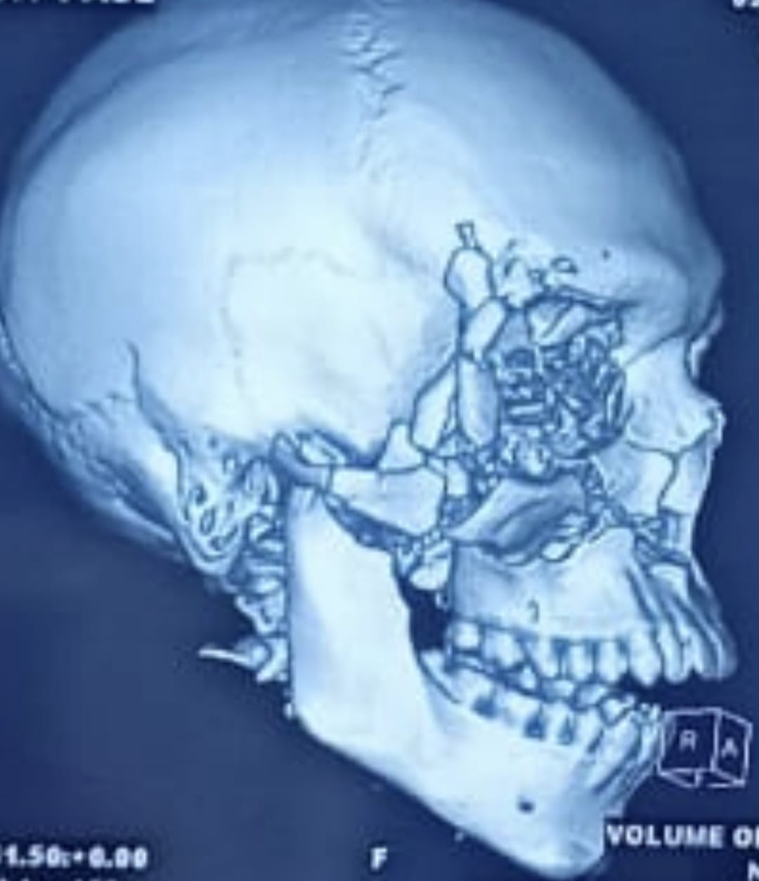Zygomatic bone fracture