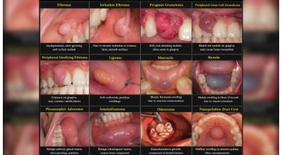 Benign Cysts & Tumour Surgery