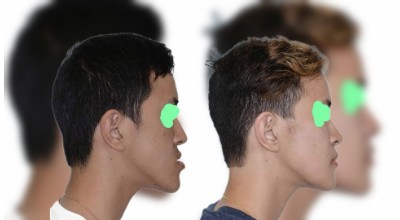 Orthognathic (Corrective Jaw) Surgery