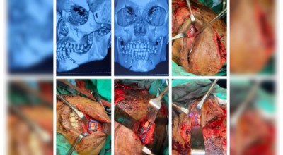 Maxillofacial Trauma & Fracture Management