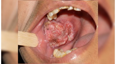 Oral Cancer Screening, Surgical Management and Reconstruction Surgery illustration