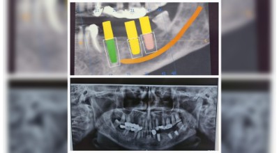 Tooth Implant Surgery & Full-Mouth Rehabilitation
