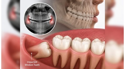 Wisdom Tooth & Impacted Tooth Removal